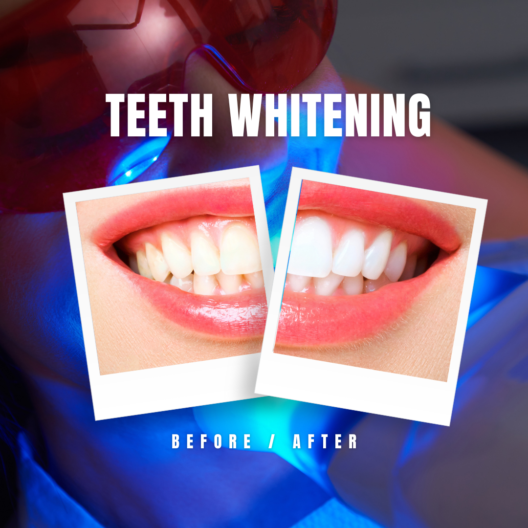 Teeth Whitening